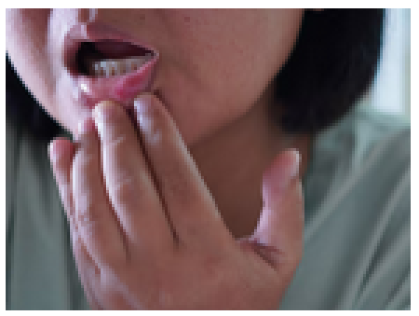 Can Food Allergies Cause Mouth Sores?