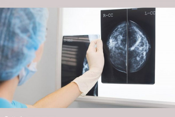 AI 'outperforms' doctors diagnosing breast cancer