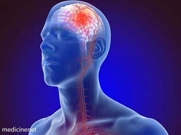 Ghana records over 12,000 cases of stroke annually-Stroke Association