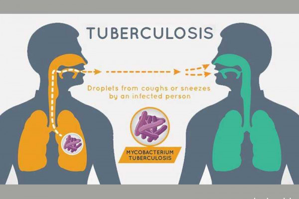 The Clock is Ticking: TB successes eroding amidst COVID-19 pandemic