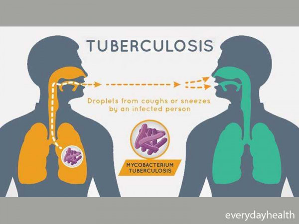 The Clock is Ticking: TB successes eroding amidst COVID-19 pandemic