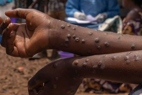 Ghana records 13 new Mpox cases, Total infections now 947