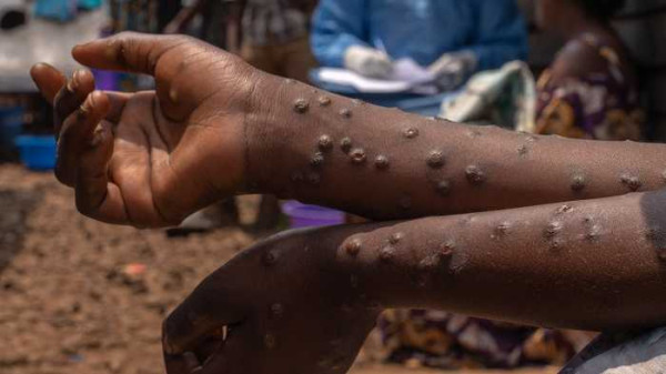 Ghana records 13 new Mpox cases, Total infections now 947