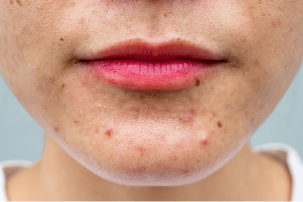 Hormonal Acne Can Happen at Any Age. Here’s How to Deal