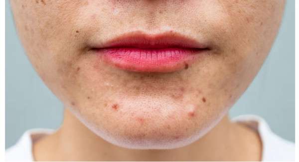 Hormonal Acne Can Happen at Any Age. Here’s How to Deal