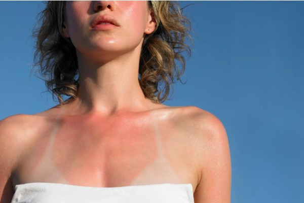 7 Body Parts People Always Miss with Sunscreen