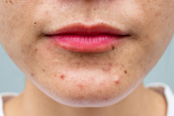 Hormonal Acne Can Happen at Any Age. Here’s How to Deal