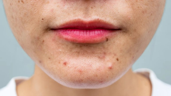 Hormonal Acne Can Happen at Any Age. Here’s How to Deal